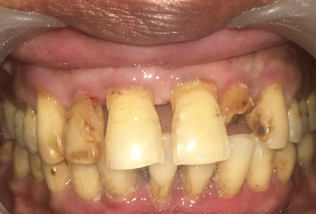 🦷 What is Pyorrhea? Causes, Symptoms, Prevention & Treatment