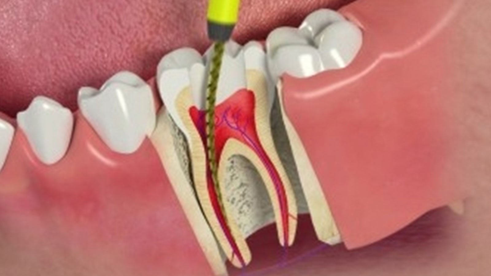 root canal images ambala cannt dental clinic